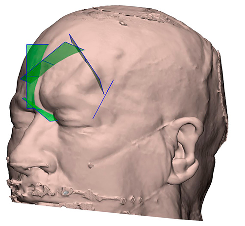 NP Tumor craneal