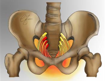 neuralgia del pudendo